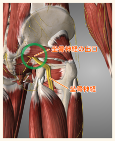 坐骨神経痛